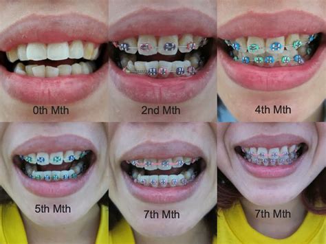 braces colors that stand out.